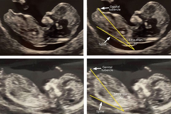 ultrasound scan pics of a baby boy and baby girl showing how nub theory is used to predict boy or girl